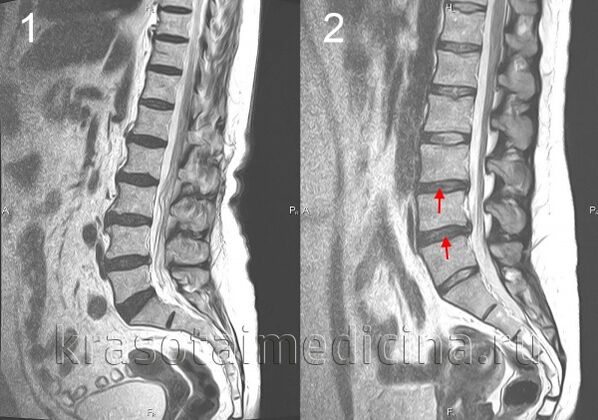 A gerinc osteochondrosis